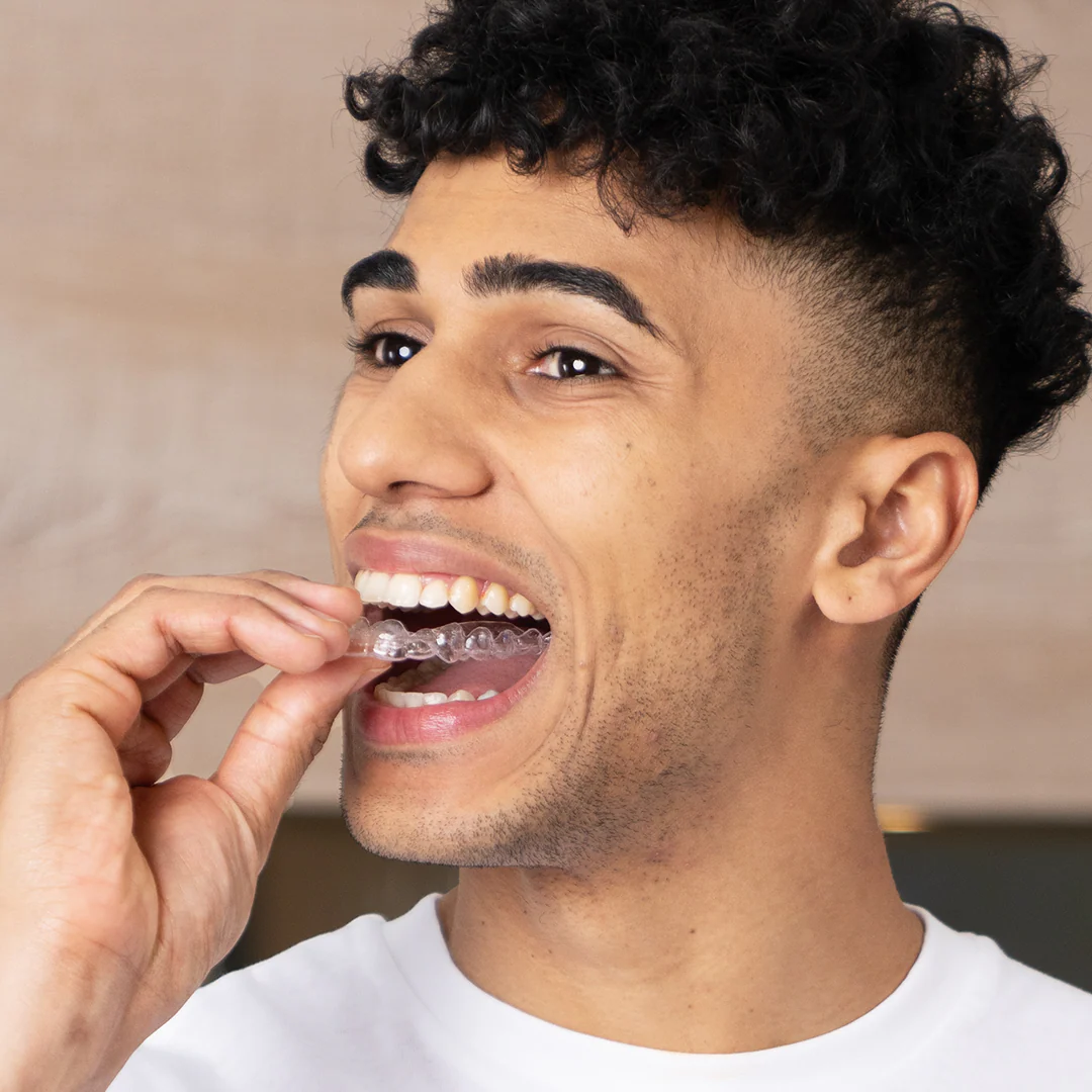 Clear aligners - Image 4