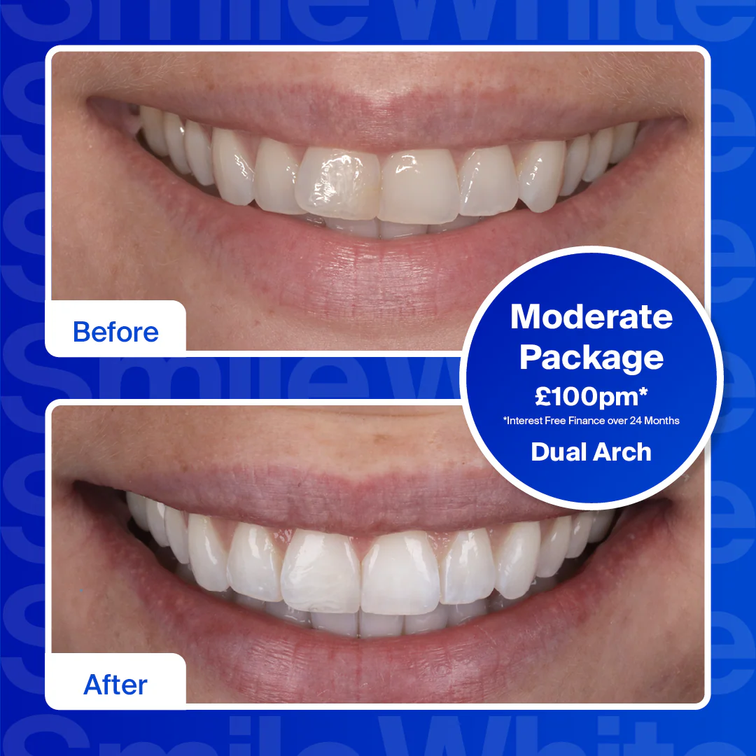 Clear Aligners - Dual Arch (top and bottom teeth)/Refresh - Image 4