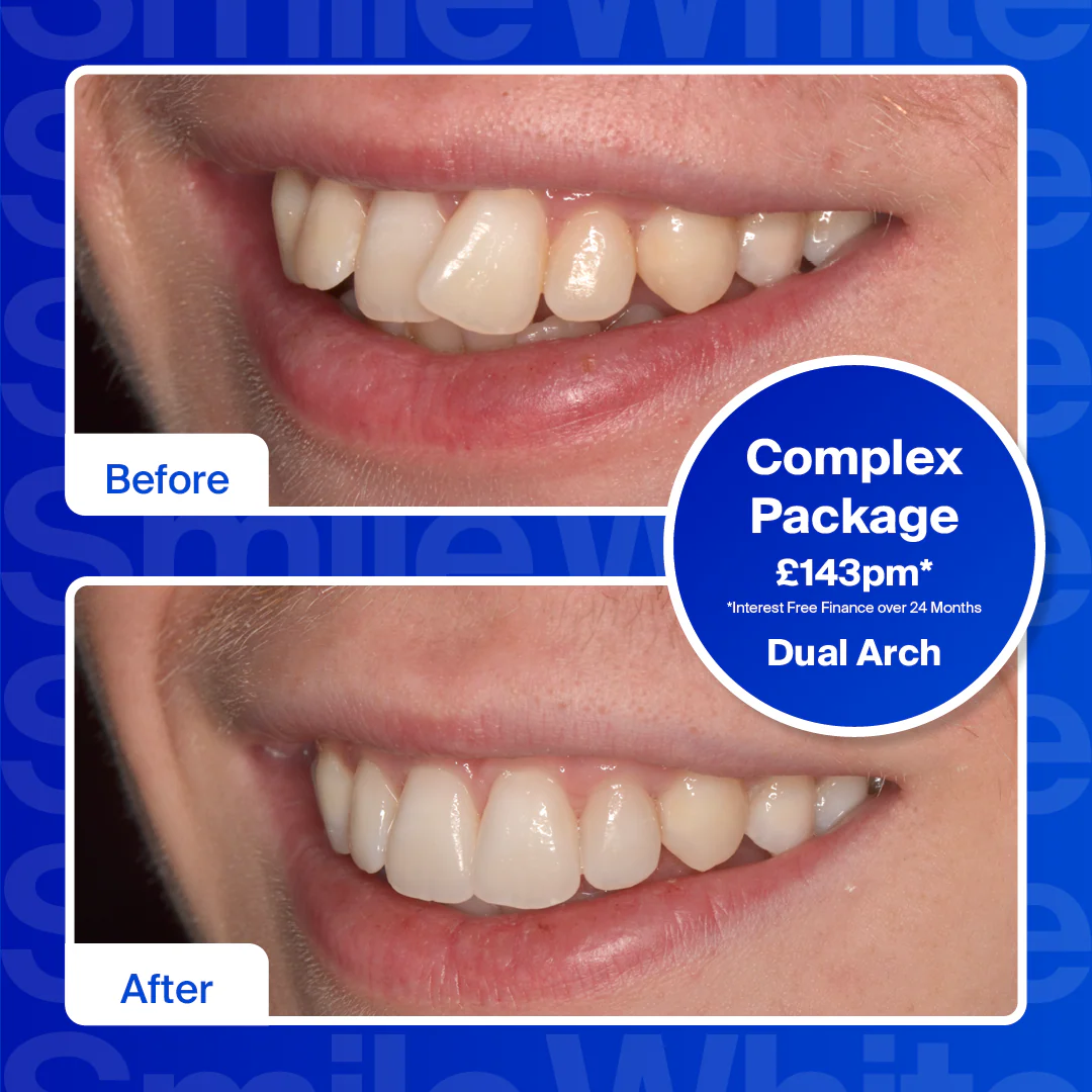 Clear Aligners - Single Arch (top or bottom teeth)/Mild - Image 3